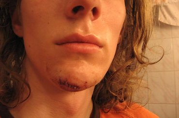 #broda #wypadek #szwy #witcher